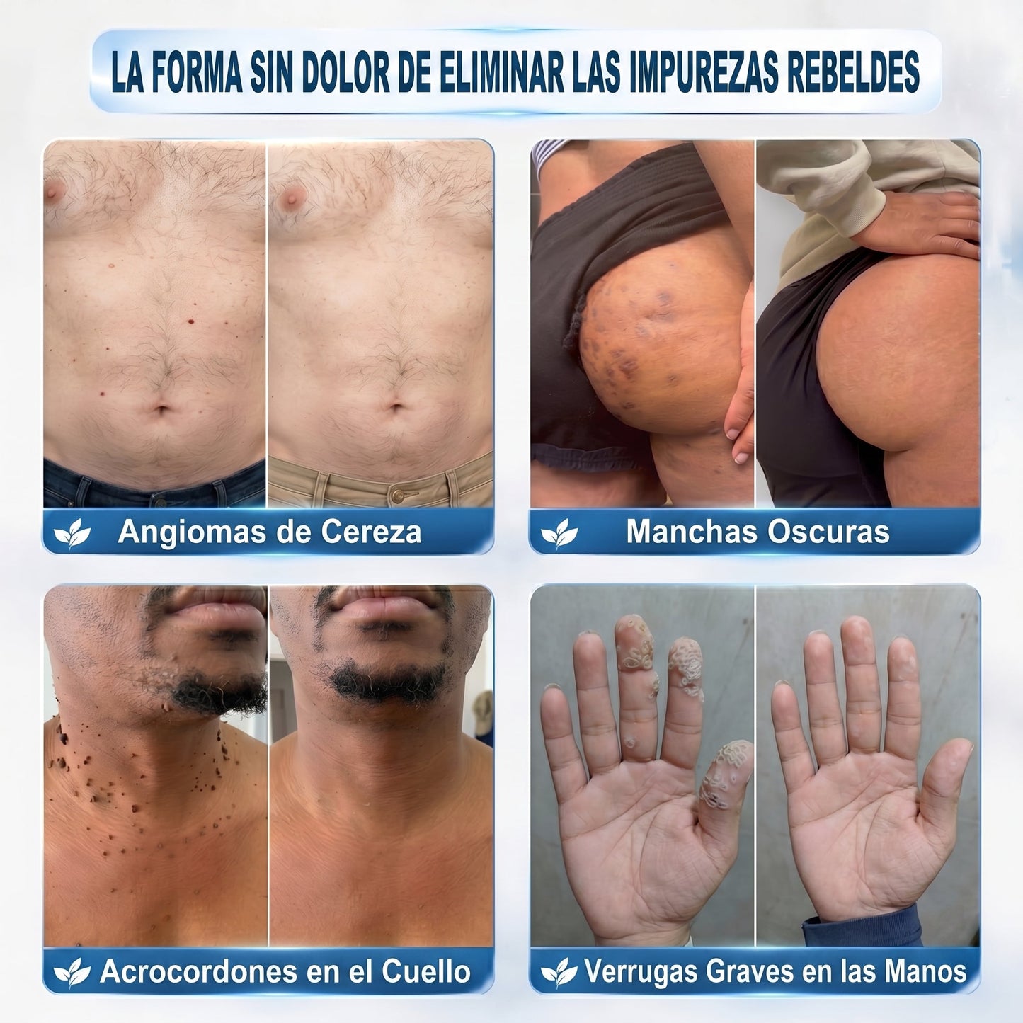 👩‍⚕️🎉𝑻𝒊𝒆𝒏𝒅𝒂 𝑶𝒇𝒊𝒄𝒊𝒂𝒍 | 𝑵𝐞𝒌𝐢𝐬𝐬® 🌿 𝑀𝑖𝑐𝑟𝑜𝑎𝑔𝑢𝑗𝑎𝑠 𝑃𝑖𝑒𝑙 𝐼𝑚𝑝𝑒𝑐𝑎𝑏𝑙𝑒 𝐸𝑙𝑖𝑚𝑖𝑛𝑎𝑐𝑖ó𝑛 𝐷𝑒 𝑉𝑒𝑟𝑟𝑢𝑔𝑎𝑠 𝑃𝑎𝑟𝑐ℎ𝑒 (𝑃𝑎𝑟𝑎 𝑎𝑐𝑟𝑜𝑐𝑜𝑟𝑑𝑜𝑛𝑒𝑠, 𝑝𝑒𝑞𝑢𝑒ñ𝑎𝑠 𝑖𝑚𝑝𝑒𝑟𝑓𝑒𝑐𝑐𝑖𝑜𝑛𝑒𝑠 𝑐𝑢𝑡á𝑛𝑒𝑎𝑠, 𝑣𝑒𝑟𝑟𝑢𝑔𝑎𝑠, 𝑙𝑢𝑛𝑎𝑟𝑒𝑠, 𝑚𝑎𝑛𝑐ℎ𝑎𝑠 𝑑𝑒 𝑙𝑎 𝑒𝑑𝑎𝑑 𝑦 𝑝𝑟𝑜𝑏𝑙𝑒𝑚𝑎𝑠 𝑑𝑒 𝑝𝑖𝑔𝑚𝑒𝑛𝑡𝑎𝑐𝑖ó𝑛.)