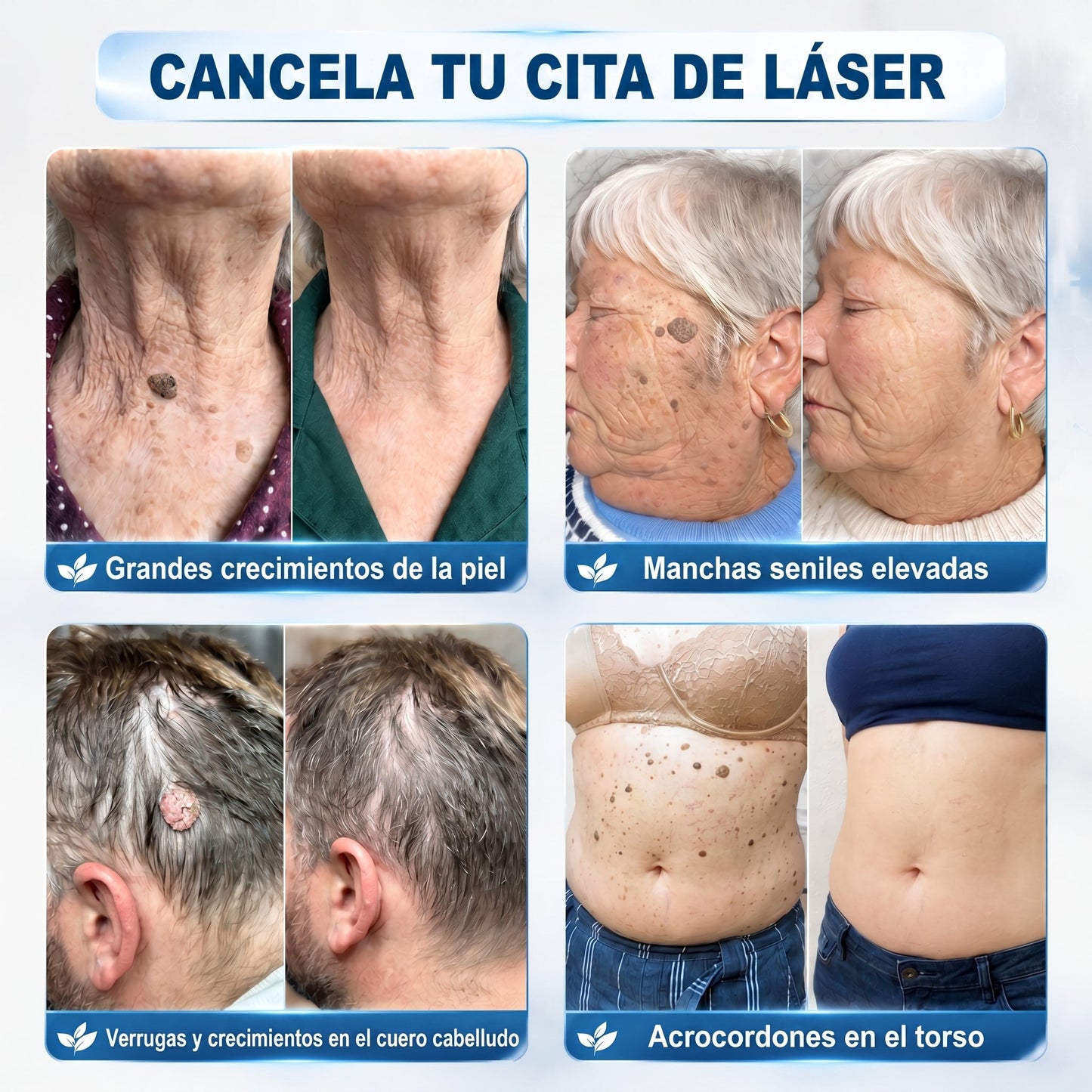 👩‍⚕️🎉𝑻𝒊𝒆𝒏𝒅𝒂 𝑶𝒇𝒊𝒄𝒊𝒂𝒍 | 𝑵𝐞𝒌𝐢𝐬𝐬® 🌿 𝑀𝑖𝑐𝑟𝑜𝑎𝑔𝑢𝑗𝑎𝑠 𝑃𝑖𝑒𝑙 𝐼𝑚𝑝𝑒𝑐𝑎𝑏𝑙𝑒 𝐸𝑙𝑖𝑚𝑖𝑛𝑎𝑐𝑖ó𝑛 𝐷𝑒 𝑉𝑒𝑟𝑟𝑢𝑔𝑎𝑠 𝑃𝑎𝑟𝑐ℎ𝑒 (𝑃𝑎𝑟𝑎 𝑎𝑐𝑟𝑜𝑐𝑜𝑟𝑑𝑜𝑛𝑒𝑠, 𝑝𝑒𝑞𝑢𝑒ñ𝑎𝑠 𝑖𝑚𝑝𝑒𝑟𝑓𝑒𝑐𝑐𝑖𝑜𝑛𝑒𝑠 𝑐𝑢𝑡á𝑛𝑒𝑎𝑠, 𝑣𝑒𝑟𝑟𝑢𝑔𝑎𝑠, 𝑙𝑢𝑛𝑎𝑟𝑒𝑠, 𝑚𝑎𝑛𝑐ℎ𝑎𝑠 𝑑𝑒 𝑙𝑎 𝑒𝑑𝑎𝑑 𝑦 𝑝𝑟𝑜𝑏𝑙𝑒𝑚𝑎𝑠 𝑑𝑒 𝑝𝑖𝑔𝑚𝑒𝑛𝑡𝑎𝑐𝑖ó𝑛.)